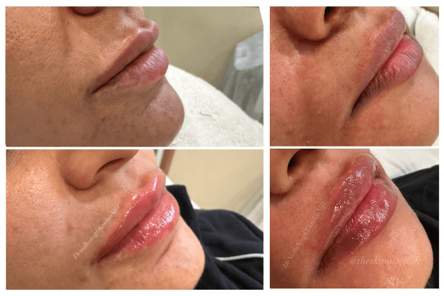 Lip Filler Treatment in Lucknow 
